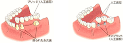 中間の歯が欠損した場合