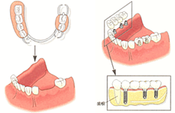 中間や端の歯が欠損した場合