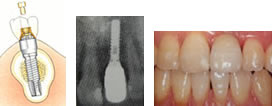 インプラント装着