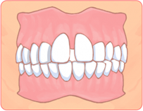 空隙歯列弓